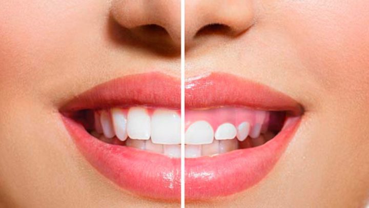 Gingivectomia (Corte de encías) Gingivectomia (Corte de encías)